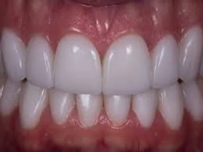 Protetico - Dentaduras - Proteses - Consertos