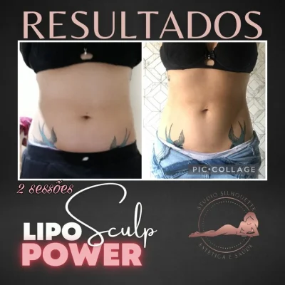 Liposculp Power Estética em Pinhais