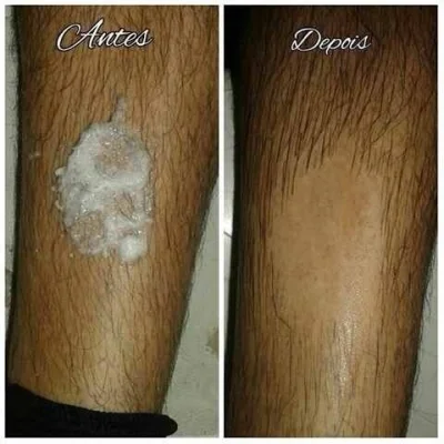 Depilação Masculina